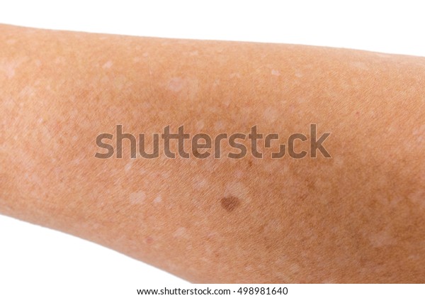 腕の内側に白い点のようなものが増えてます。 - 何が原因で、- Yahoo!知恵袋