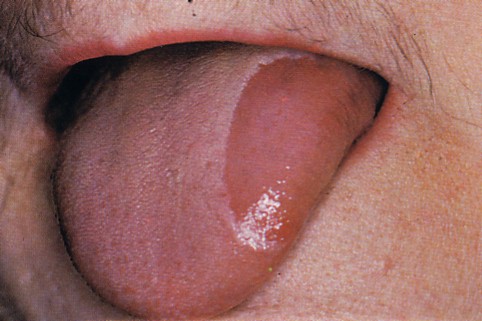 溝状舌 こうじょうぜつ とは 溝状舌の痛みの原因と対処法