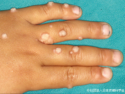 いぼ 尋常性疣贅ひびきの皮ふ科 北九州市八幡西区学研都市ひびきのにある皮膚科