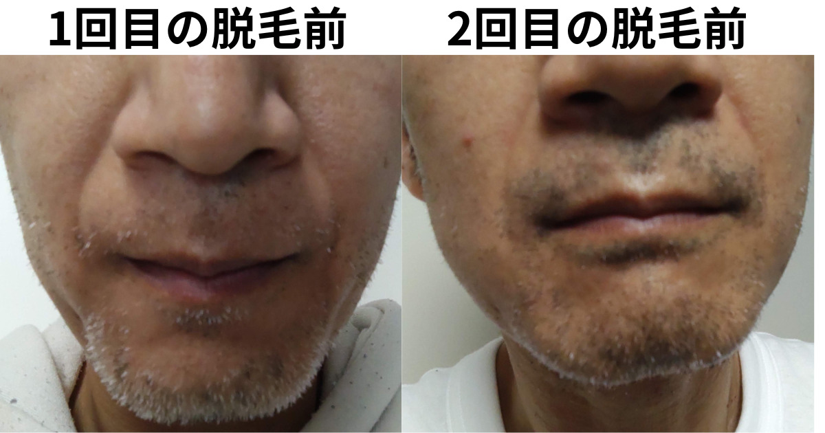 医療脱毛でヒゲが濃くなる？「どろぼうヒゲ」の原因と正しい対策を専門クリニックが解説メンズ脱毛の銀座ブライトスキンクリニック