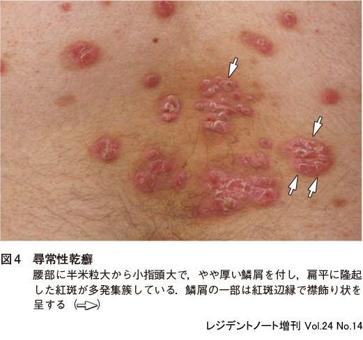 皮膚病」の25万点のロイヤリティフリー画像、写真素材、絵Shutterstock