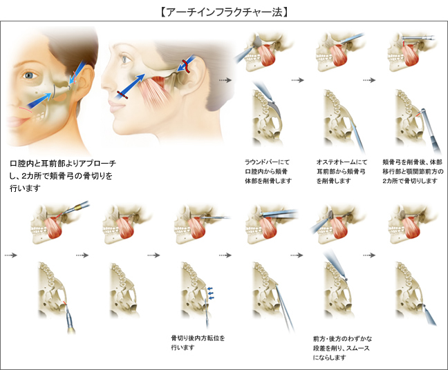 頬骨が出ている方必見！原因と目立たなくする方法を解説 - WOMクリニック銀座