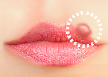 暮らし 急な下唇の腫れと少量の出血 歯科医院へ行きましたからだにいいこと