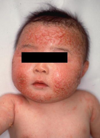 赤ちゃんの湿疹を放置するのはアレルギー発症の元。咲くらクリニック