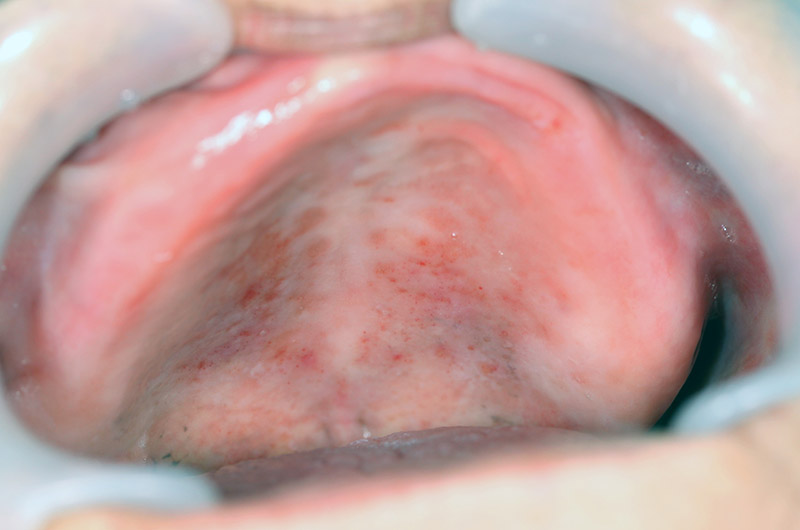 小児の口腔カンジダ症やましろ歯科口腔外科口腔外科・口腔内科福岡で親知らずの抜歯、ドライマウス、睡眠時無呼吸症候群、口腔 がん健診のことならやましろ歯科口腔外科へ。日本口腔外科学会認定専門医が治療します