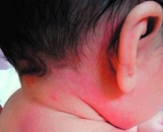 新生児の顔のかぶれにも低刺激な保湿クリームを！乳児湿疹について – HOLO