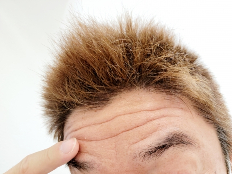 生え際前進術 公式 オザキクリニック 新宿・目黒祐天寺・羽村