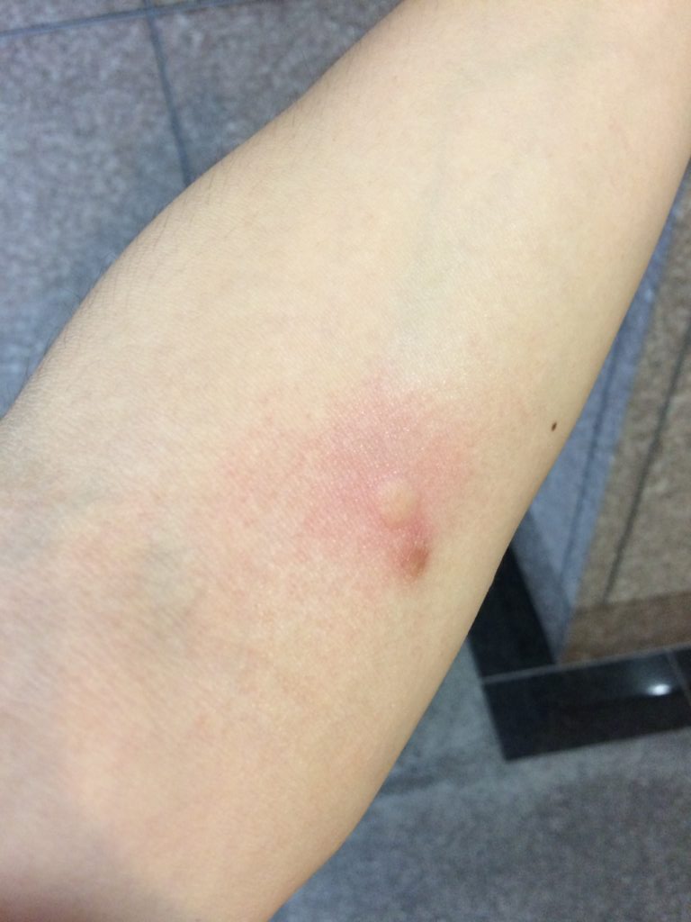 症例画像 虫刺されの症状・対処法 ひどい腫れや痒みも皮膚・爪・髪の病気All About