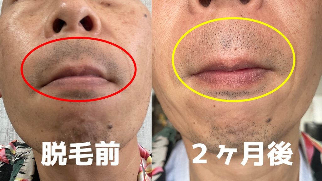 ケノン40回目の青髭の写真！加工なし！ 20回やった後、2週間休んでそこから だいたい週５のペースで強さは「８」慣れてからはサングラスも保冷剤での冷却もせず さっさとバチバチやって終わりを続けています！ 40回目で明らかに青さが消えてきましたね！！！ 治療法・肌