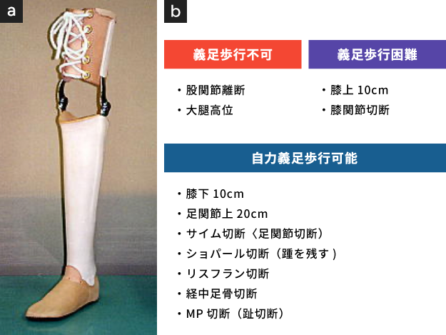 骨壊死した膝はどうなる？治る？原因と疑わしい時にすべきこと│ひざ関節症クリニック