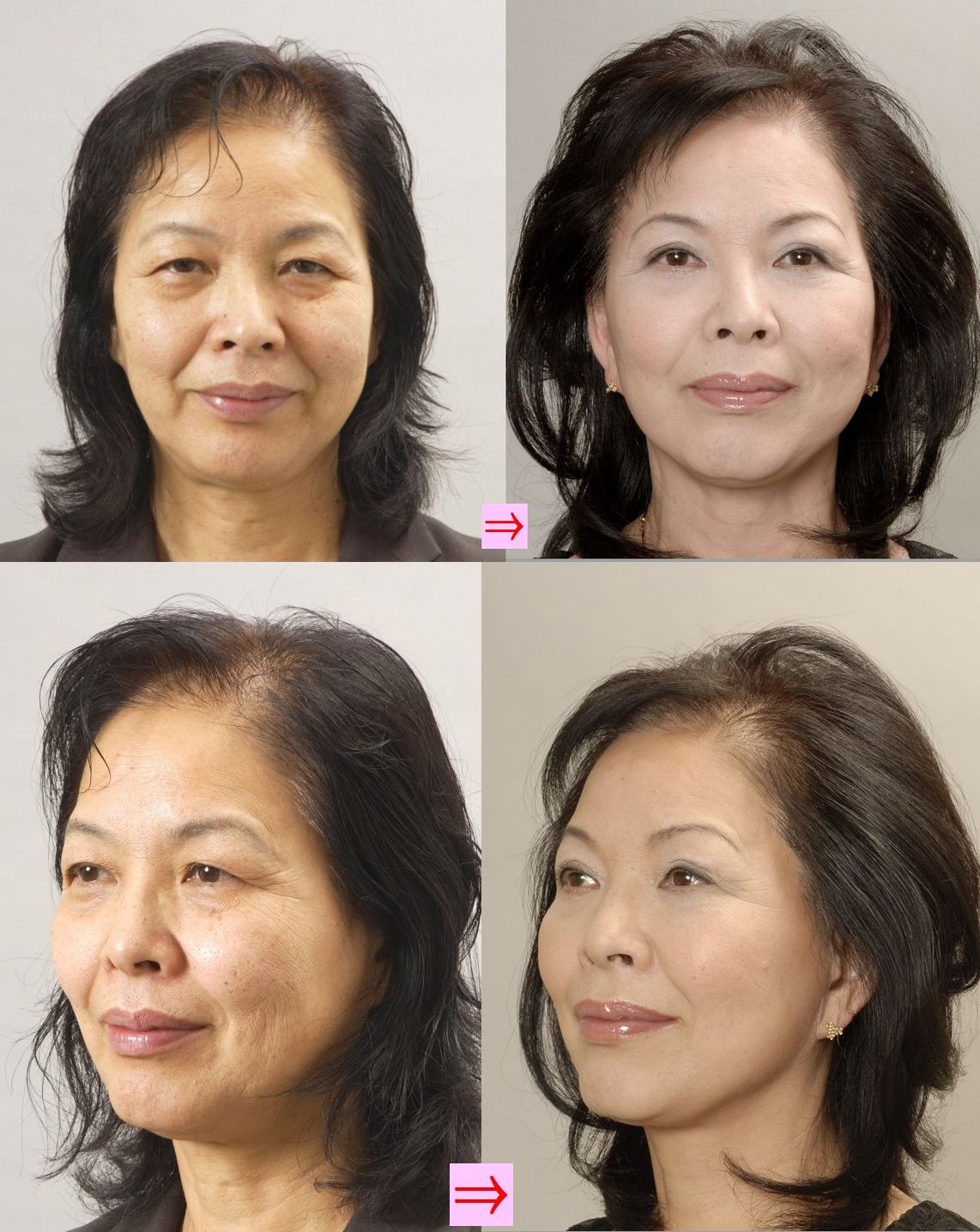 BeforeAfter大公開！美容整形で生まれ変わる BeautifulChange美容整形・美容外科ジョウクリニック 公式