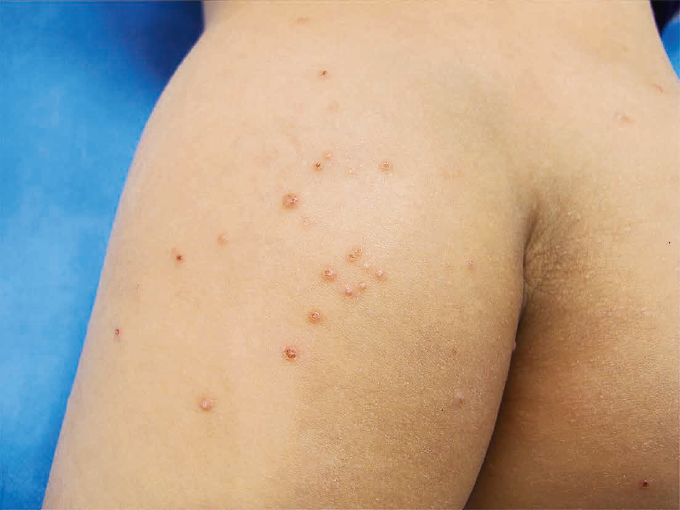 とびひと間違いやすい病気「とびひ」について詳しく知ろう皮膚科疾患情報とびひ 伝染性膿痂疹 製薬会社のマルホ