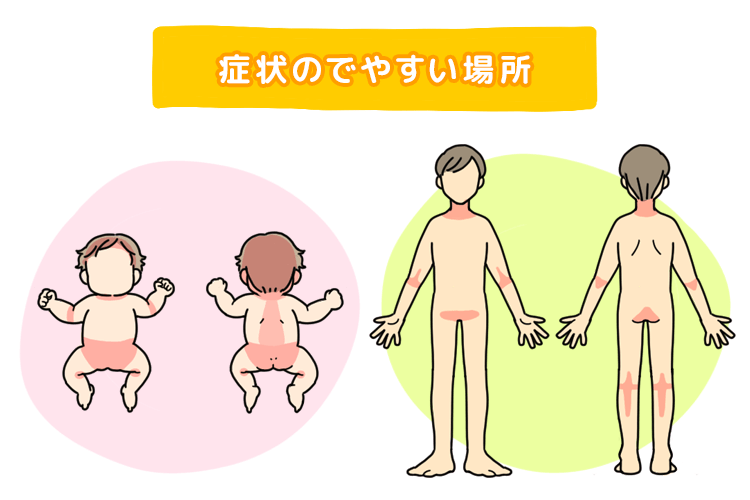おでこと頭皮にカサカサ野田市 小児科 千葉県 こどもの花粉症 こどもの漢方 喘息 アトピー性皮膚炎 アレルギー 結節性痒疹 たんぽぽこどもクリニック