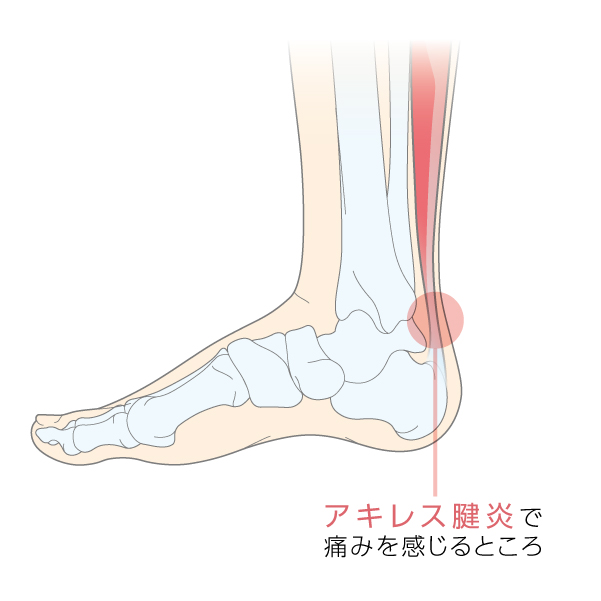 アキレス腱が痛い！ランナーに頻発するアキレス腱痛のメカニズムと治療・リハビリ方法 - RUNNING CLINIC