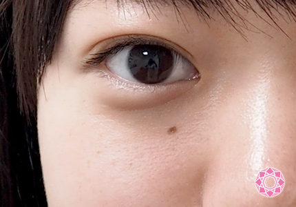 ホクロは目の際でも除去できる👩‍⚕️ まぶたのホクロでお悩みだった当院の患者様ですが、縫わずに高周波メス サージトロン で除去して4ヶ月後、赤みも残さずきれいに消えています👏まぶたにホクロやイボがあると視界に入ってジャマになることもあり、見た目にも