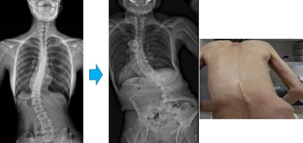 側弯 そくわん 症大阪の整体 遠方から大勢来院する創輝鍼灸整骨院