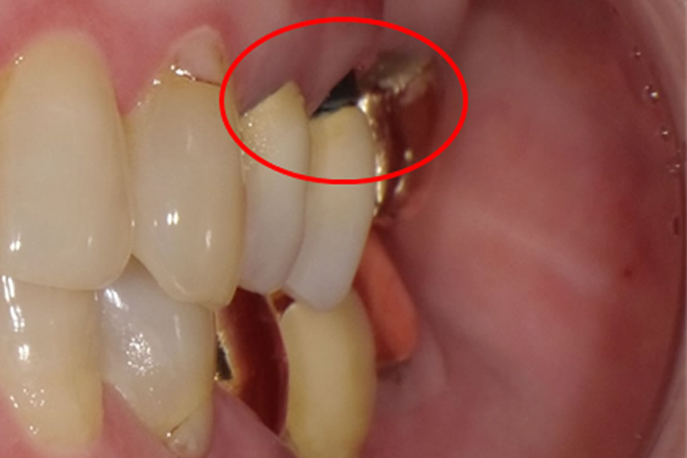 歯肉移植で下がった歯ぐきをとりもどす治療について知ってほしい３つのこと - ヴェリ歯科クリニック