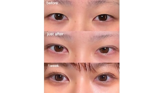 二重整形カウンセリング時に聞くべき4つのこと 理想の二重になる方法- 湯田クリニック 銀座 RY グループ