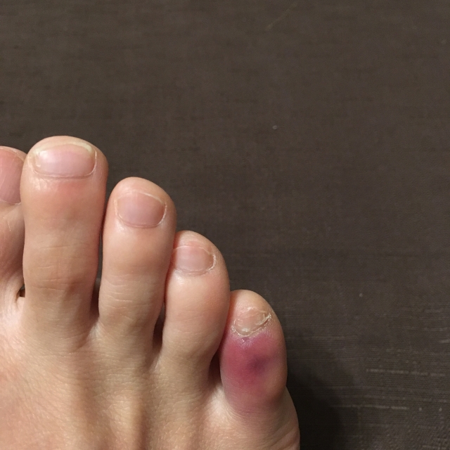 打撲の内出血や腫れを軽減する処置法を紹介-パルモ神保町整骨院