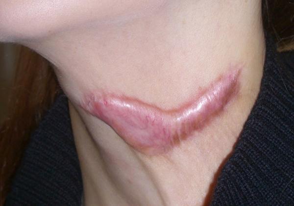 顎下の脂肪吸引後 傷跡がケロイド状になって痛いです脂肪吸引 顔の脂肪吸引 の治療への不安 痛み・失敗・副作用