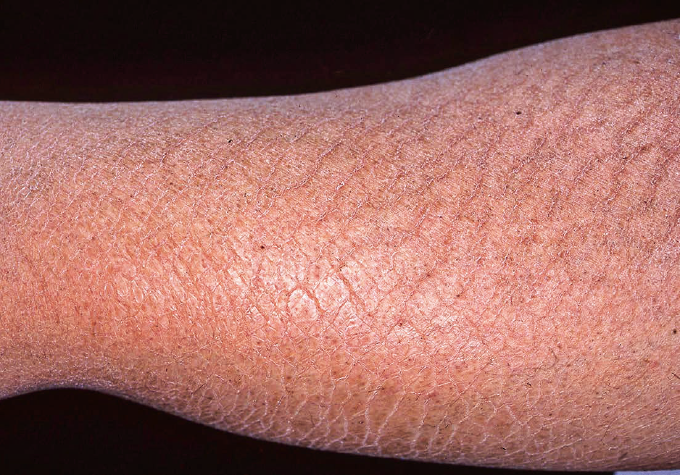 私は尋常性魚鱗癬の病気を患ってます。 - なかなか異性と付き合- Yahoo!知恵袋