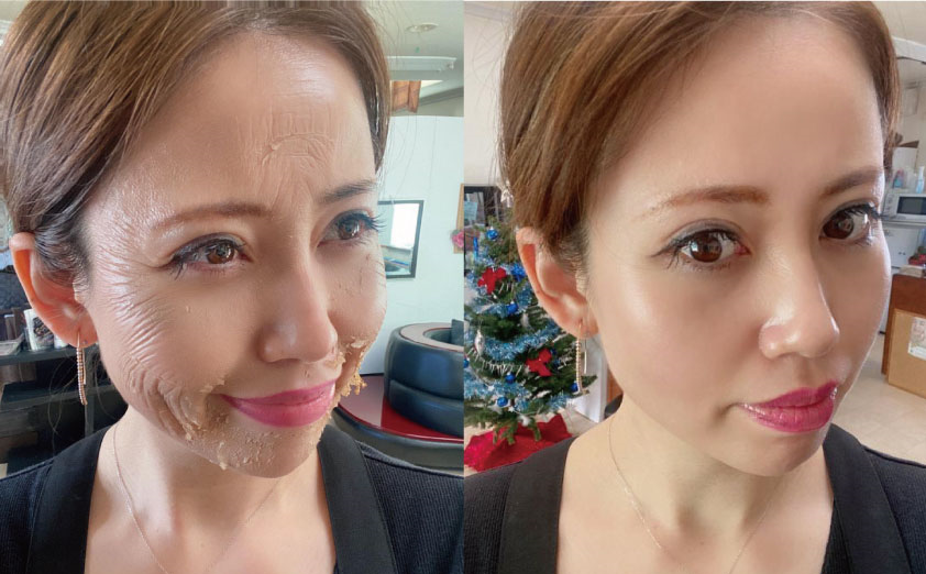 ニキビの芯出しって、自分でやってもいいよね？ ニキビQ&Aインタビュー, スキンケア, ビューティー, エンタメnon-no web