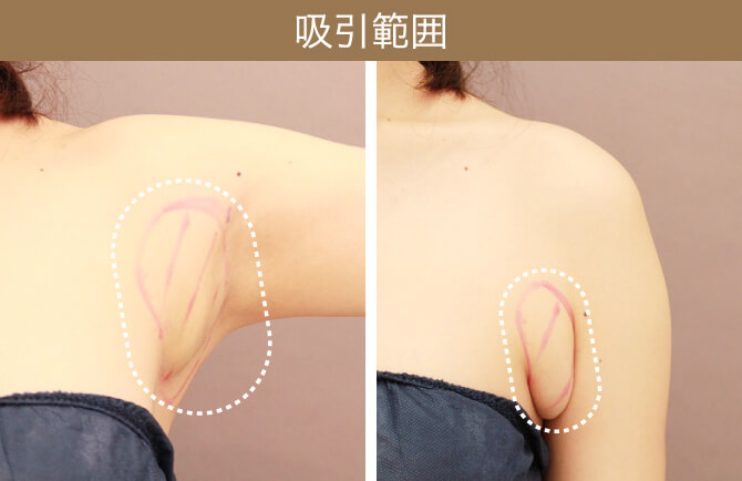 ブツブツ、黒ずみ、シワ・たるみあなたの「ワキ」大丈夫？美ST ONLINE