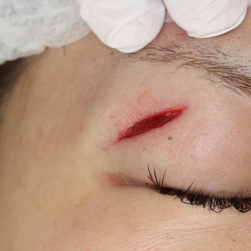 肝斑、炎症後色素沈着治療の症例写真横浜・桜木町の テティス横濱美容皮膚科