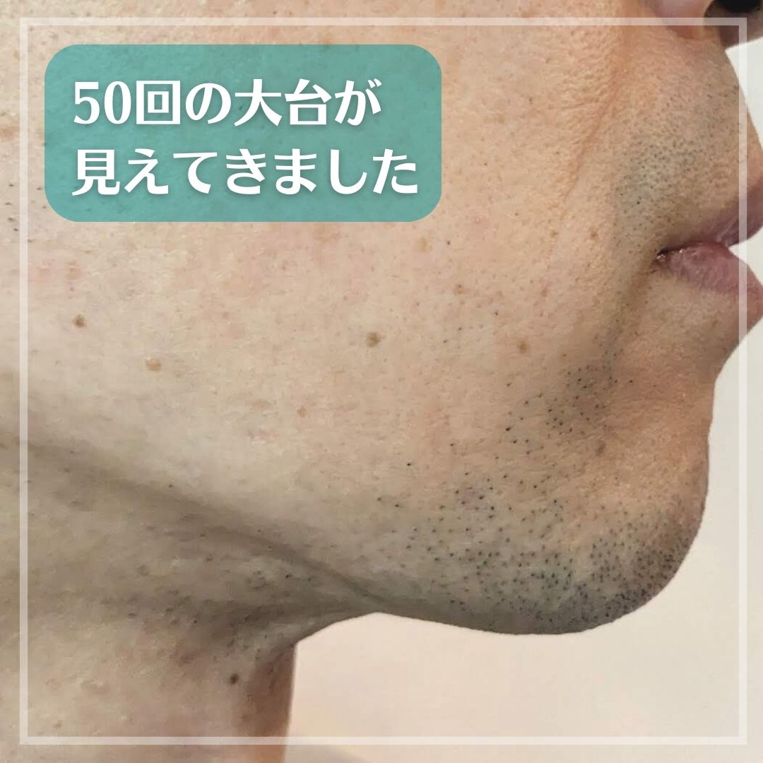 男性必見 脱毛器ケノンで青ヒゲと決別しよう - 脱毛つるはだ