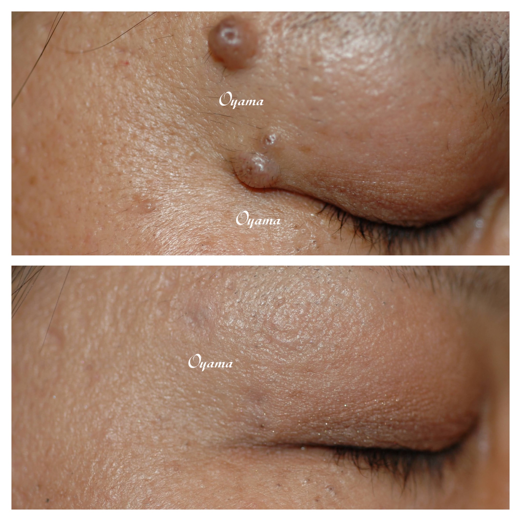 目の周りのほくろ除去 目の上・目の下 大山皮膚科足立区 五反野駅1分の皮膚科