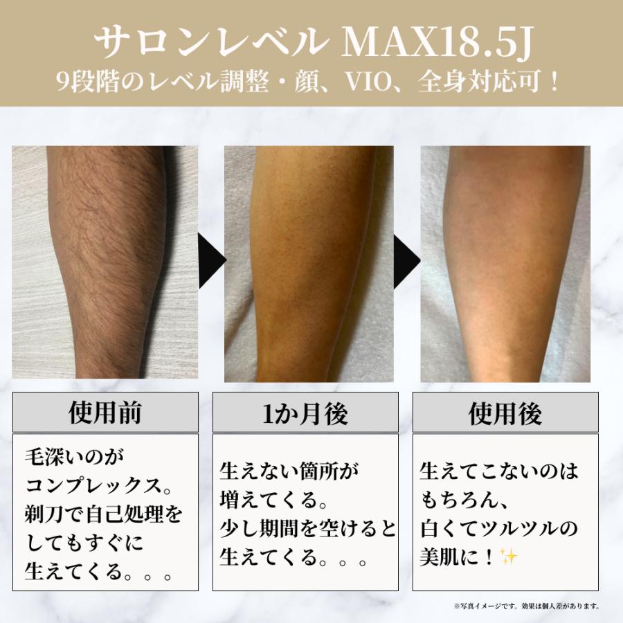 脱毛器 メンズ家庭用脱毛器おすすめ9選男のヒゲ・VIOに