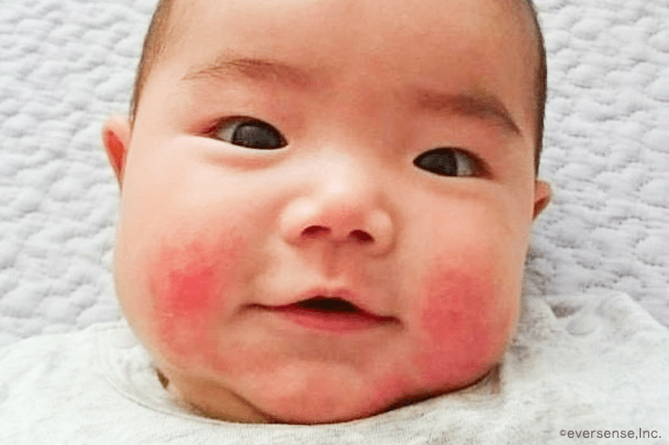 よだれかぶれなのかアレルギーなのか 赤ちゃんの病気・ケガ ベビーカレンダー専門家相談