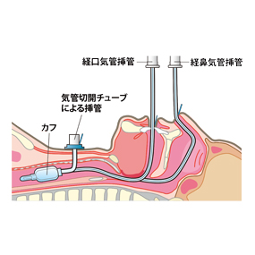 NPPV マスク式人工呼吸器医学関連イラスト素材 」のイラスト素材 2239590525Shutterstock