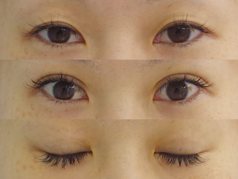 クマ取り後 内出血がひどい・消えない？ ダウンタイムがいつまでか気になる方へ冷やすことで早く治す横浜市鶴見の形成・美容外科 エムズクリニック