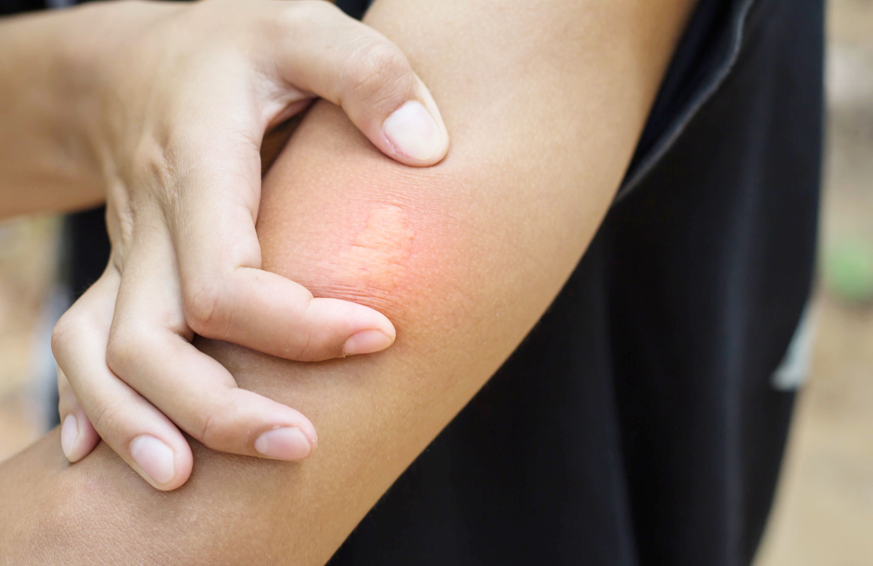 虫さされの症状・原因くすりと健康の情報局