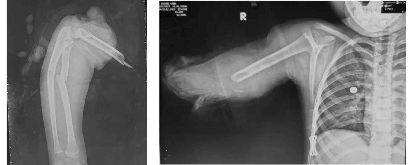 交通事故で切断した前腕の、切断面の痛みに対するカテーテル治療実例オクノクリニック