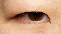 まぶたのむくみには、美容鍼灸で頭皮アプローチ！自然なリフトアップ効果で目元を引き締める東京・渋谷・恵比寿で鍼灸を専門に行う赤岩治療院