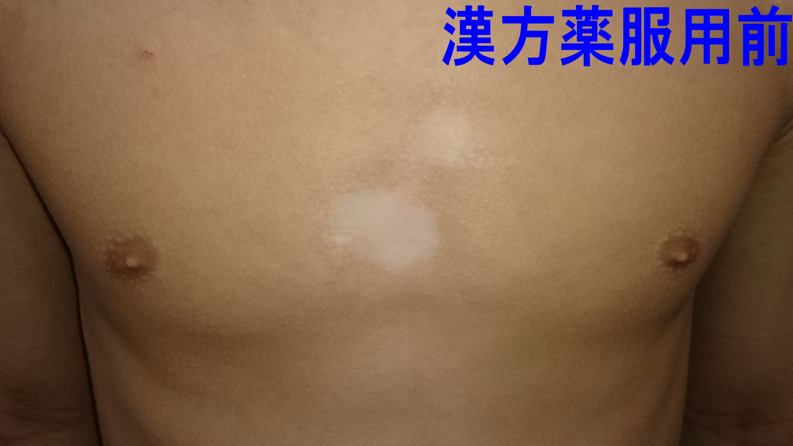 えぬくりブログ: 当院の尋常性白斑 はくはん 治療