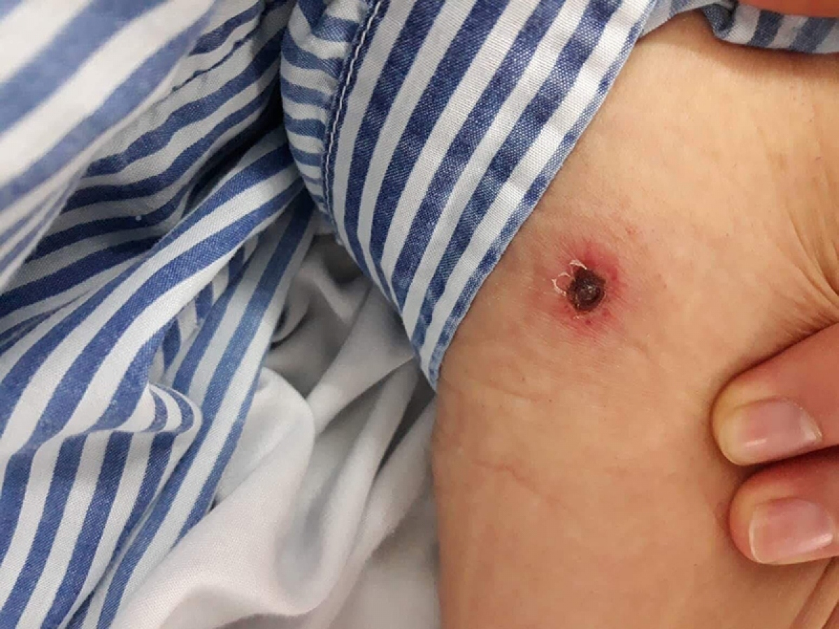 つつが虫病 』に注意しましょう - 岡山県ホームページ 感染症情報センター