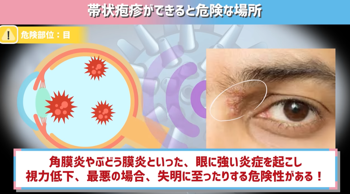 帯状疱疹 の治療 新田皮膚科形成外科足立区新田皮膚科・小児皮膚科・形成外科