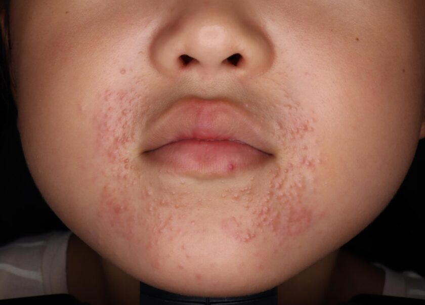 鼻 ブツブツ」の4.7万点のロイヤリティフリー画像、写真素材、絵Shutterstock