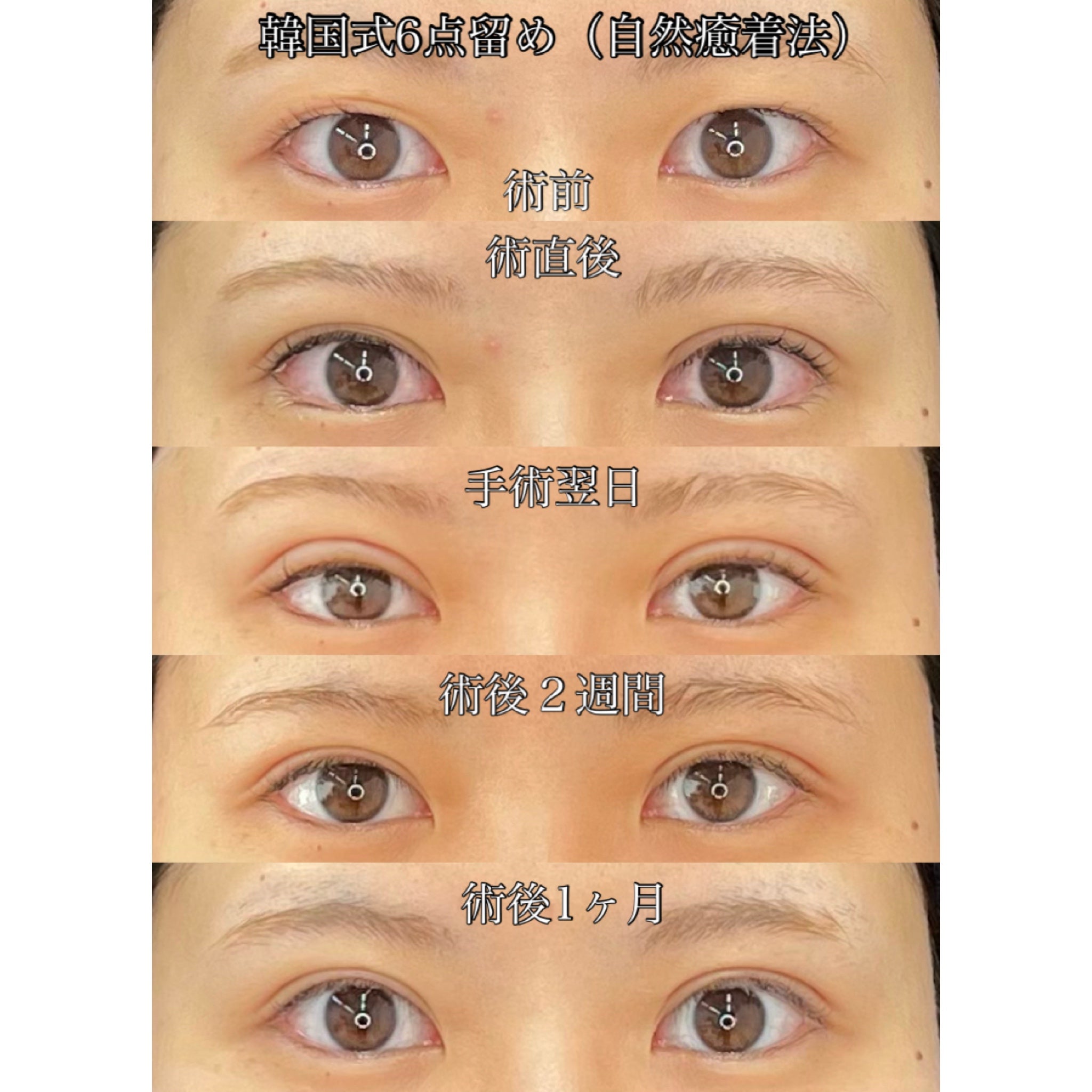 福岡で二重埋没法で魅力的な瞳にWクリニック福岡院 美容皮膚科・美容外科・美容内科