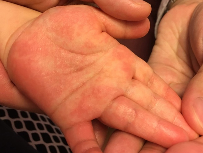 手のひらがかゆい原因は病気？ストレス？対処法を解説ハルメク美と健康