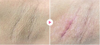 医師監修 背中のぶつぶつの正体は？原因や治療法について解説はじめての美容医療ジェイメック