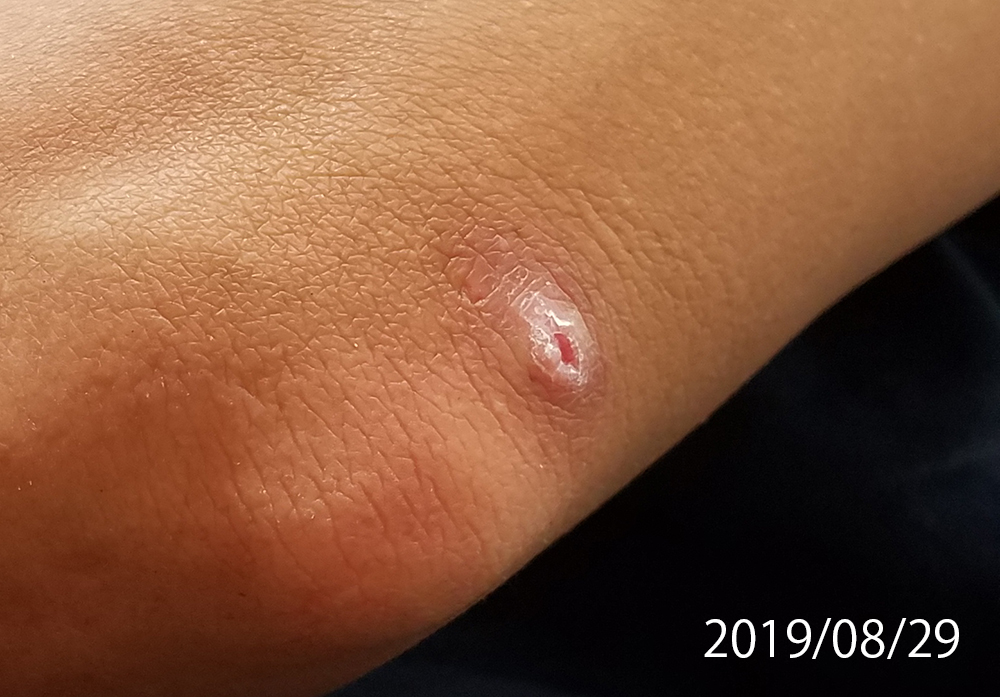 ブヨ刺された跡」の写真素材8件の無料イラスト画像Adobe Stock