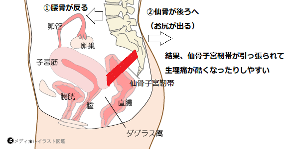 仙骨・坐骨滑液包炎 - 古東整形外科・リウマチ科