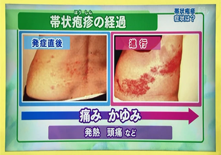 帯状疱疹の症状と原因とは - ゆかい整体
