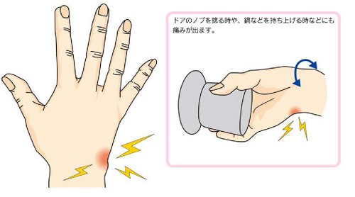 手首、指の痛み〜原因と対処法〜後藤田整骨院徳島県吉野川市