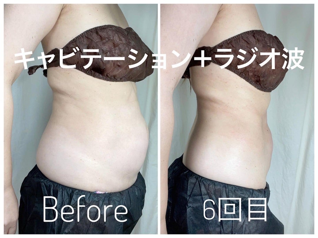 キャビテーション - からだよかよね朝倉市の整体マッサージ・骨盤矯正・ダイエット