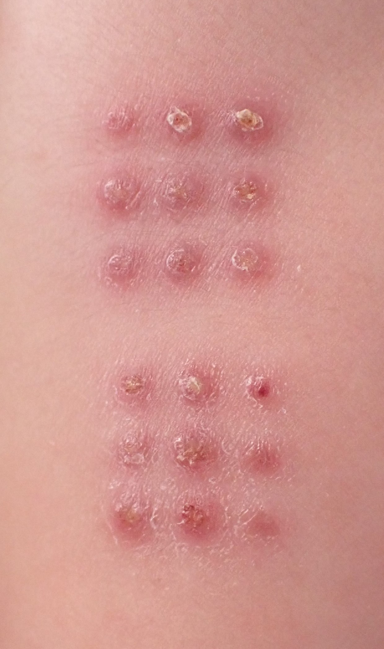 インフルエンザの予防接種で腫れる原因。副反応が出やすい人は？Medicalook メディカルック